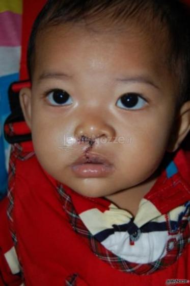 Un bambino indonesiano affetto da labioschisi dopo l’intervento