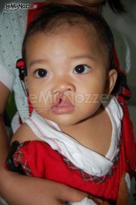 Un bambino indonesiano affetto da labioschisi