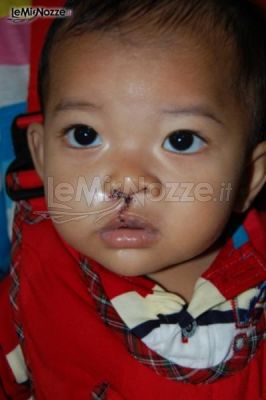 Un bambino indonesiano affetto da labioschisi dopo l’intervento
